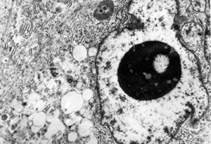 F,64y. | adenocarcinoma F,64y. | adenocarcinoma